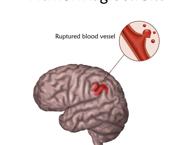 Diagrama del accidente cerebrovascular (ACV) hemorrágico