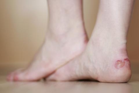 Persona con ampolla en los pies